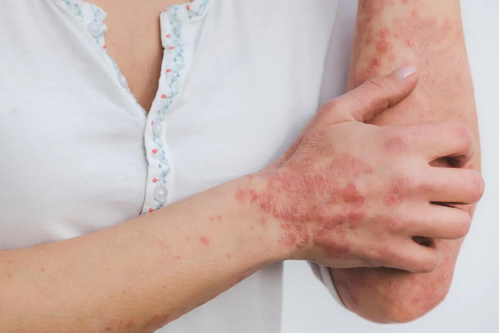 Psoriasis: mitos que agravan el estigma en pacientes